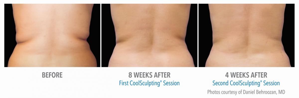 Cool sculpting love handles